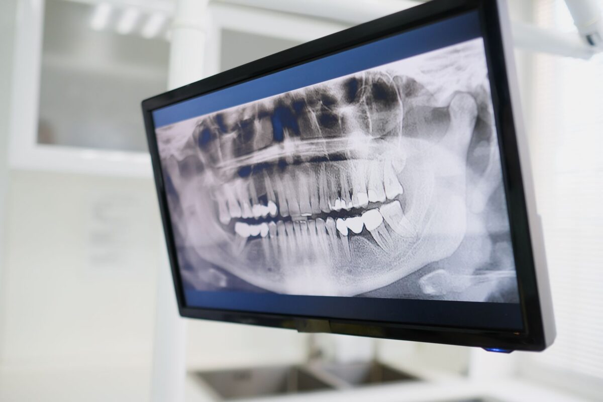 Are Dental X-Rays Necessary? Debunking Common Myths