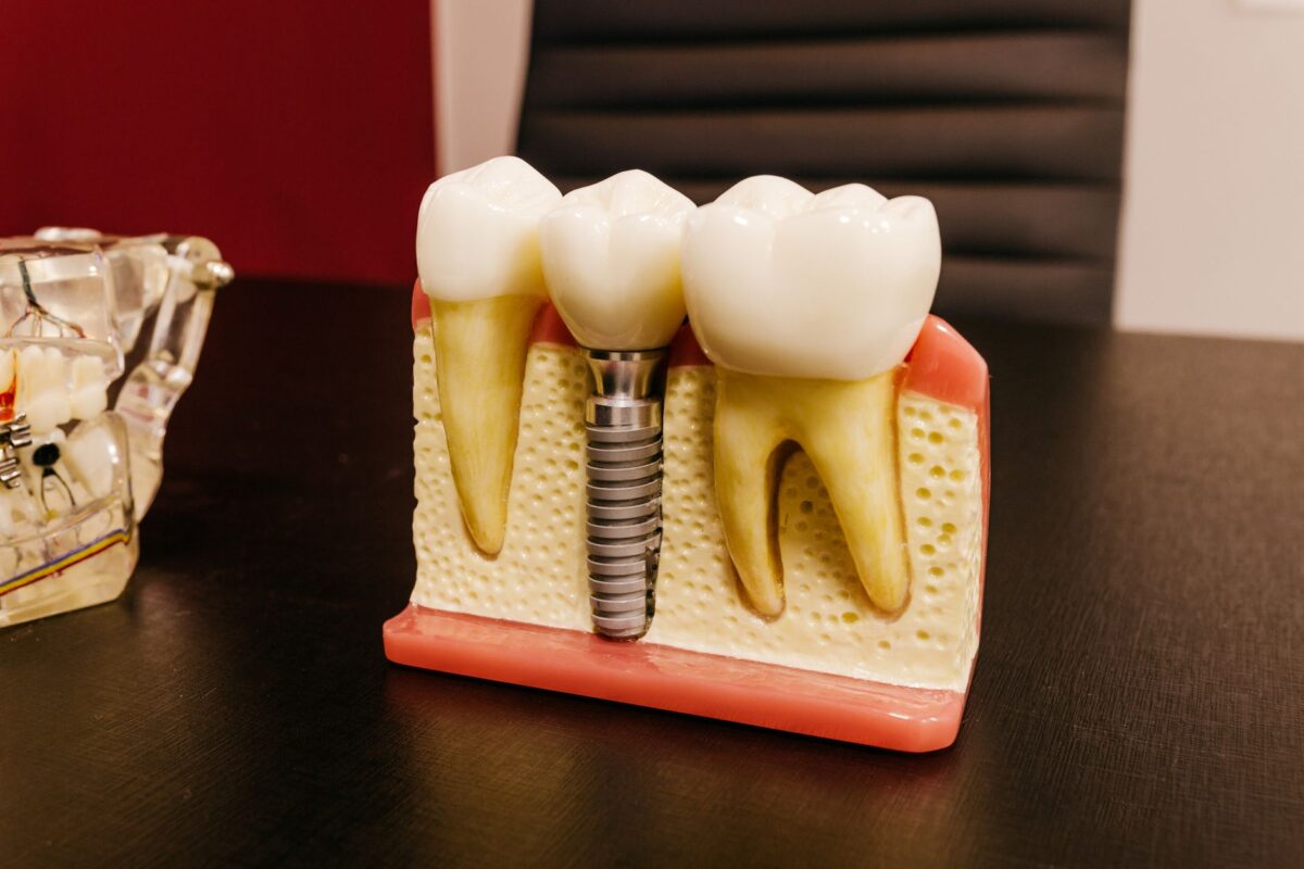 Essential Recovery Tips After Dental Implant Surgery Near Me