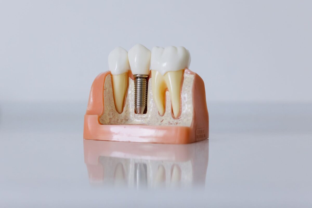 Exploring the Benefits of Dental Implants for a Healthier Smile