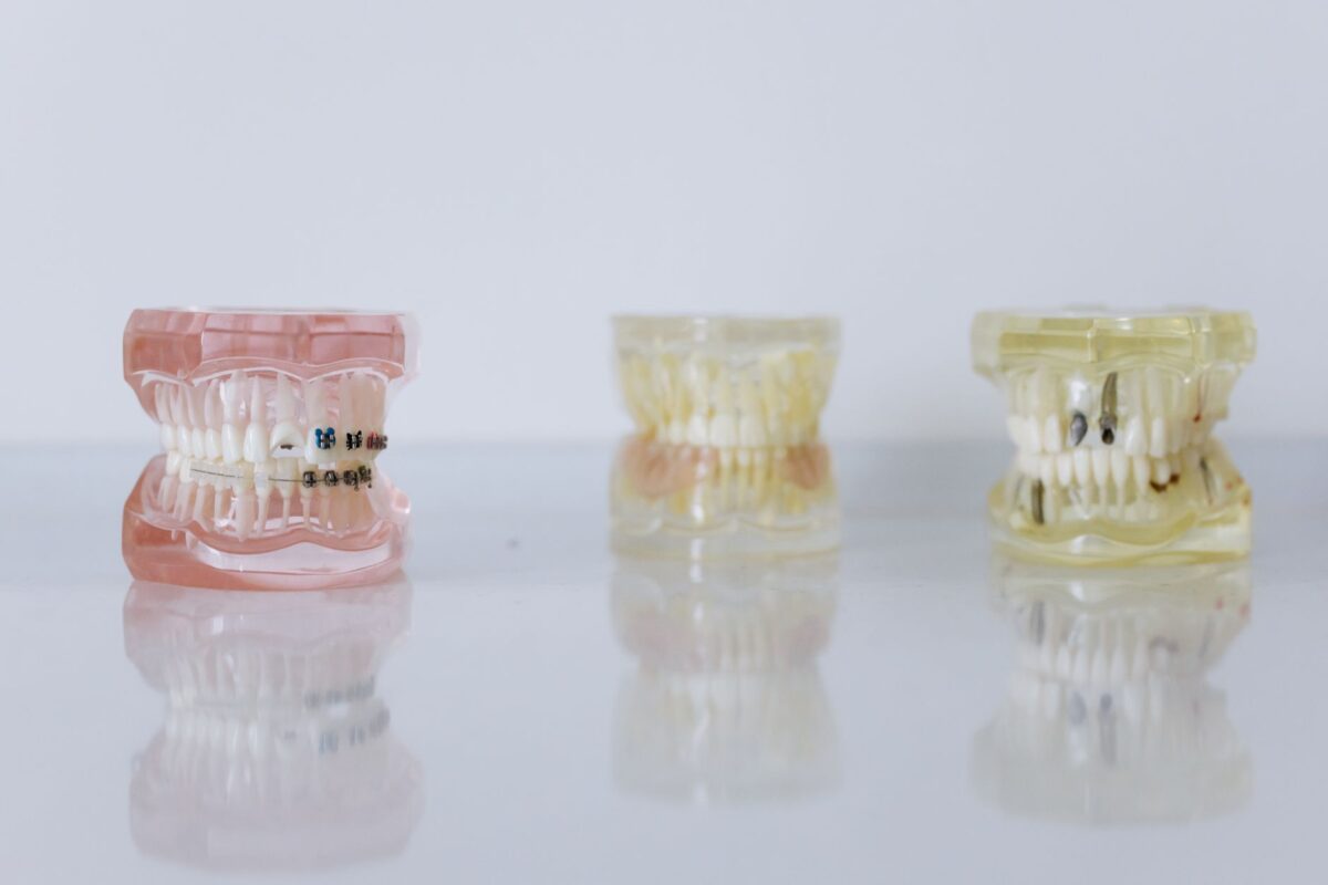 Exploring Alternatives to Dental Implants: What Are Your Options?