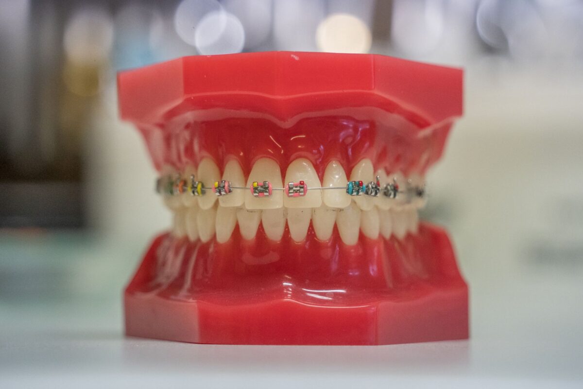 How Invisalign Works: A Comprehensive Guide